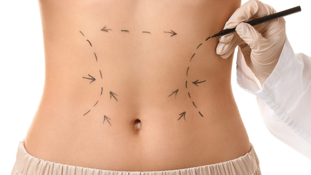 Abdominoplastia pelo sus